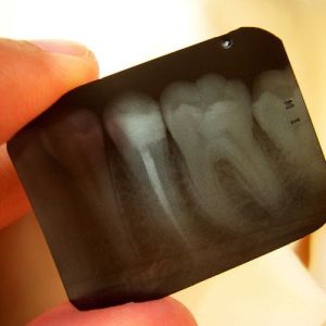 See The Full Picture On Dental X-Rays